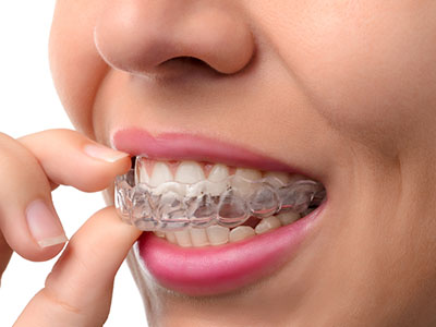 True Vine Dental Care | Oral Cancer Screening, Dental Cleanings and ClearCorrect reg 