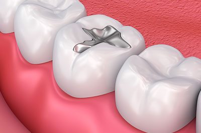 True Vine Dental Care | Implant Dentistry, Invisalign reg  and Dental Fillings
