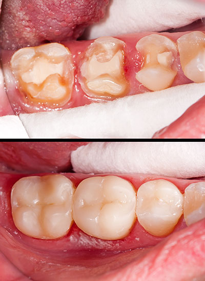 True Vine Dental Care | Root Canals, Oral Exams and Intraoral Camera