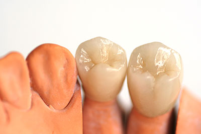 True Vine Dental Care | All-on-6 reg , Implant Restorations and Night Guards