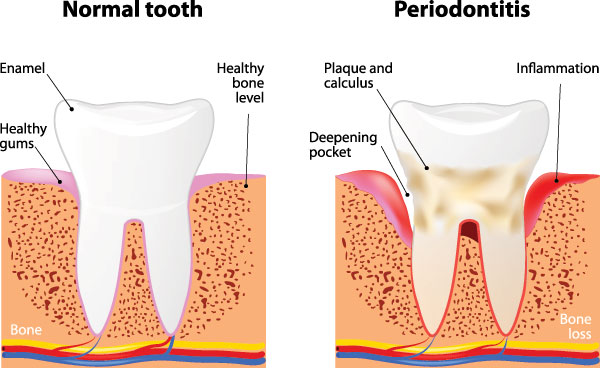 True Vine Dental Care | Implant Restorations, Implant Dentistry and Inlays  amp  Onlays