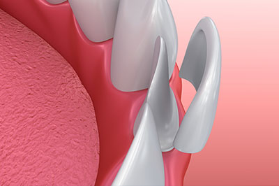 True Vine Dental Care | Crowns, ClearCorrect reg  and Oral Cancer Screening
