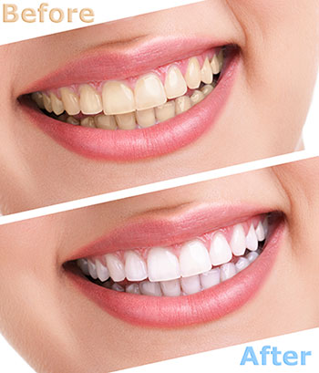 True Vine Dental Care | Intraoral Camera, Implant Restorations and Veneers